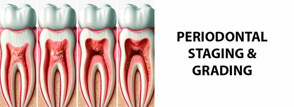 The Periodontal Staging and Grading Guide and the Symptoms