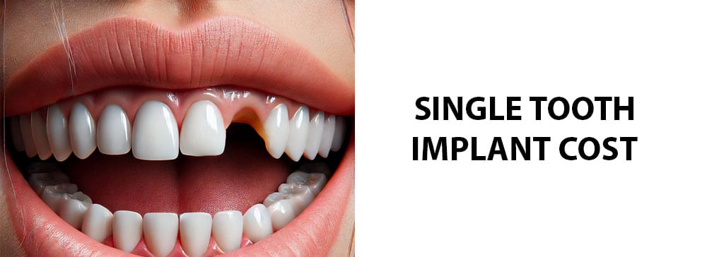 Single Tooth Implant Costs in Utah With & Without Insurance